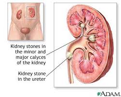 acv for kidney stones
