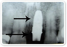 Implants 3