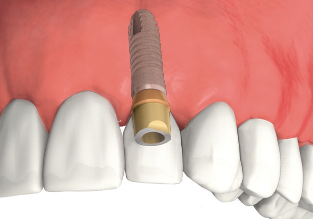 Dental Implant Smiles Central